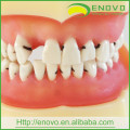 EN-L4 Peridontal Disease Dental Model with Removable Soft Gingival